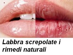 Labbra screpolate i rimedi naturali